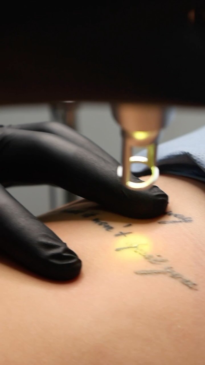 Laser Tattoo Removal at BeCammo, Malta